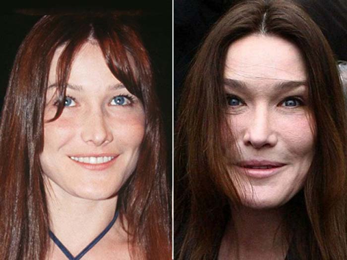 Carla Bruni - worst plastic surgeries of popular celebrities