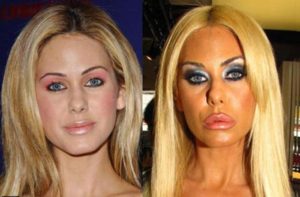 Shauna Sand - worst plastic surgeries of popular celebrities